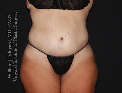 Tummy Tuck Before & After Gallery - Patient 177377 - Image 2