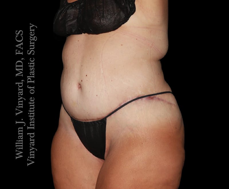 Tummy Tuck Before & After Gallery - Patient 177377 - Image 4