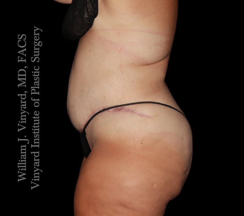 Tummy Tuck Before & After Gallery - Patient 177377 - Image 6