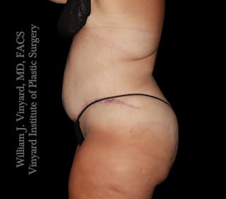 Tummy Tuck Before & After Gallery - Patient 177377 - Image 6