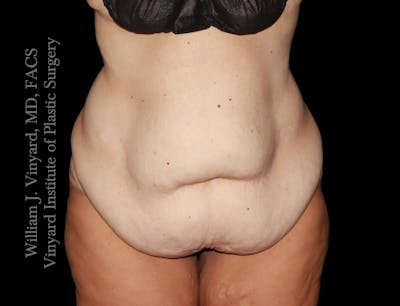 Tummy Tuck Before & After Gallery - Patient 177377 - Image 1