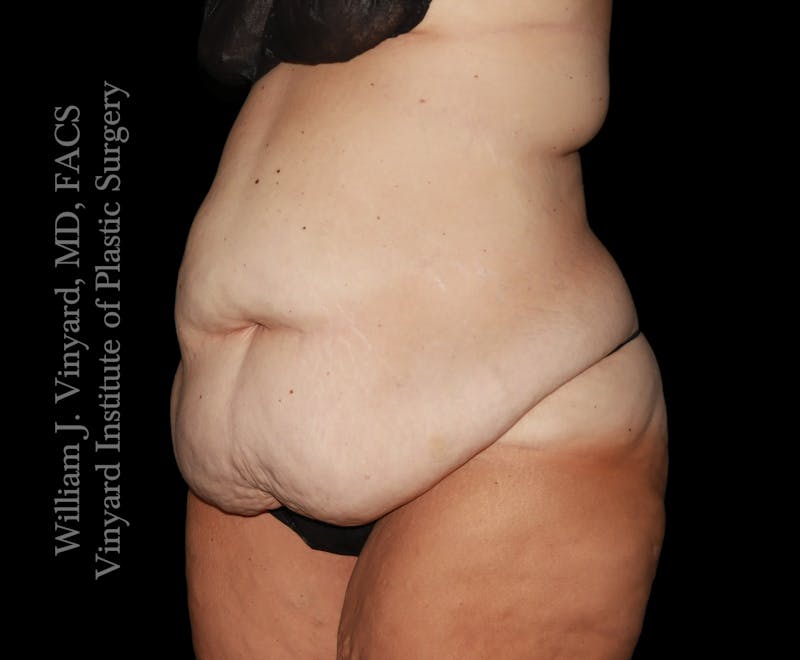 Tummy Tuck Before & After Gallery - Patient 177377 - Image 3