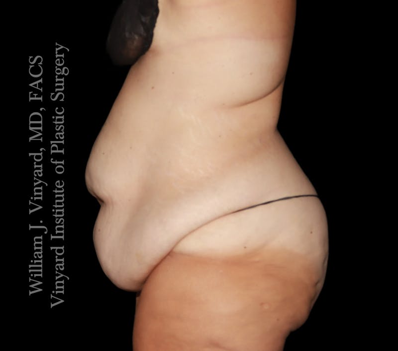 Tummy Tuck Before & After Gallery - Patient 177377 - Image 5