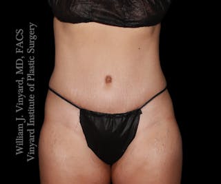 Tummy Tuck Before & After Gallery - Patient 290272 - Image 2