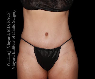 Tummy Tuck Before & After Gallery - Patient 290272 - Image 2