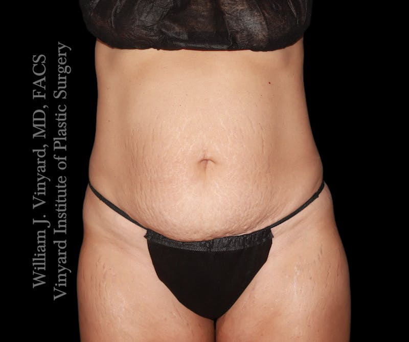 Tummy Tuck Before & After Gallery - Patient 290272 - Image 1