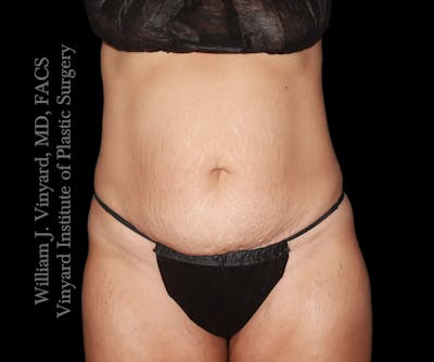 Tummy Tuck Before & After Gallery - Patient 290272 - Image 1