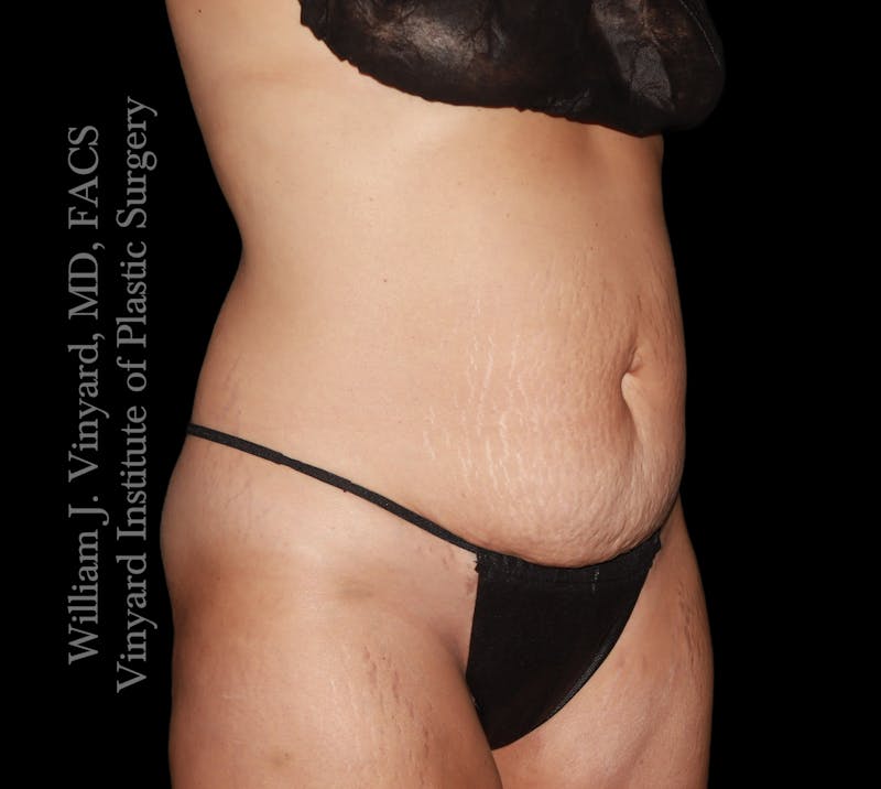 Tummy Tuck Before & After Gallery - Patient 290272 - Image 3