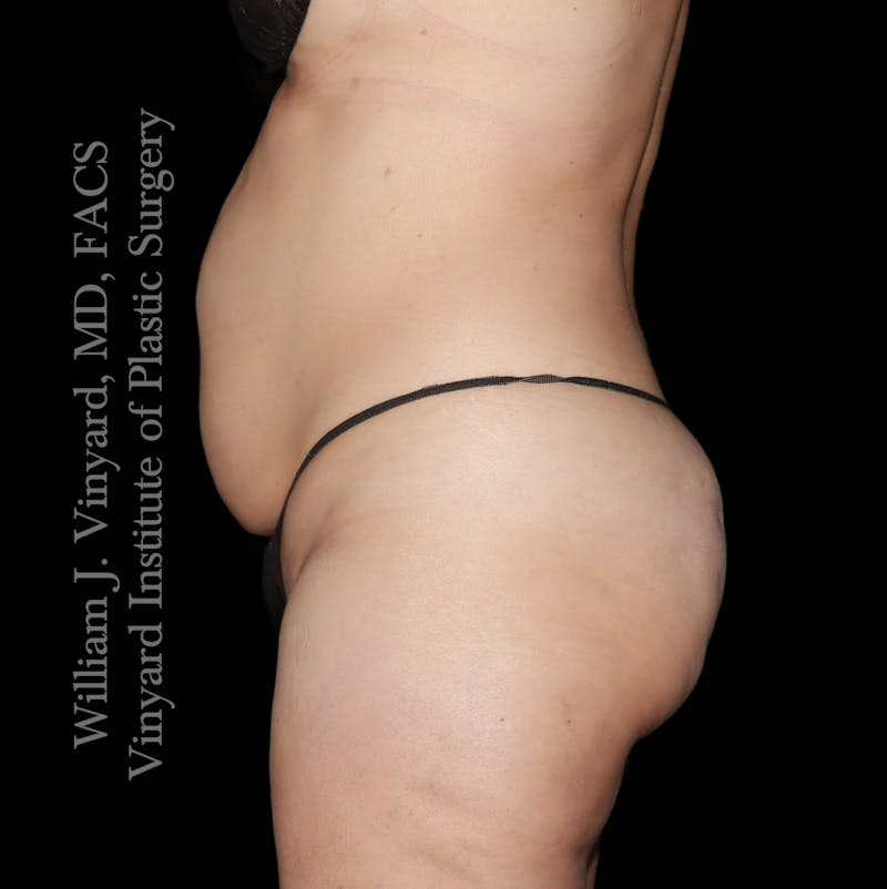 Tummy Tuck Before & After Gallery - Patient 290272 - Image 5