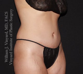 Tummy Tuck Before & After Gallery - Patient 290272 - Image 4