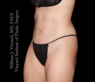 Tummy Tuck Before & After Gallery - Patient 342130 - Image 6