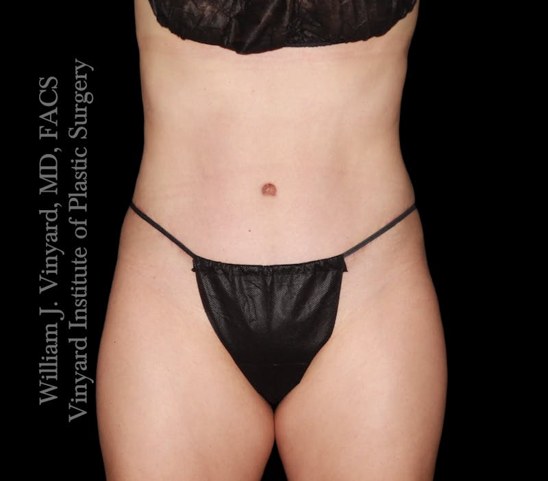 Tummy Tuck Before & After Gallery - Patient 342130 - Image 2