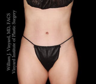 Tummy Tuck Before & After Gallery - Patient 342130 - Image 2