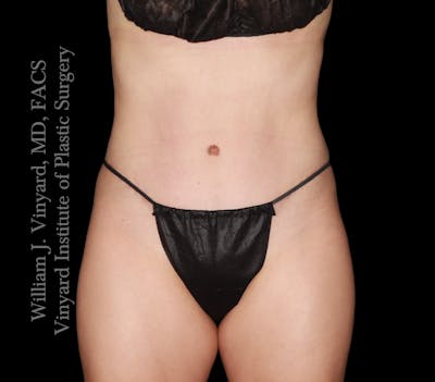 Tummy Tuck Before & After Gallery - Patient 342130 - Image 2