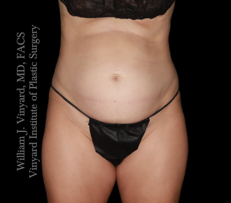 Tummy Tuck Before & After Gallery - Patient 342130 - Image 1