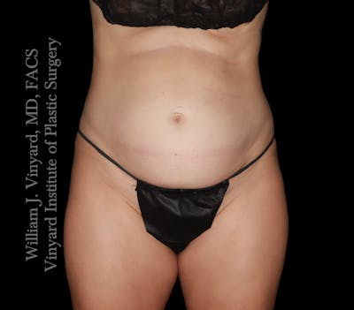 Tummy Tuck Before & After Gallery - Patient 342130 - Image 1
