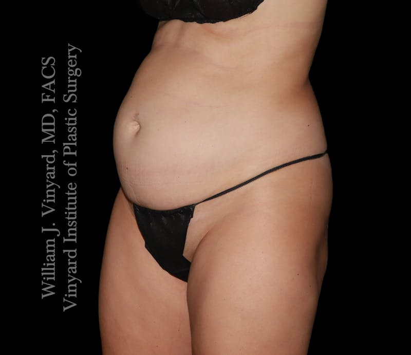 Tummy Tuck Before & After Gallery - Patient 342130 - Image 5
