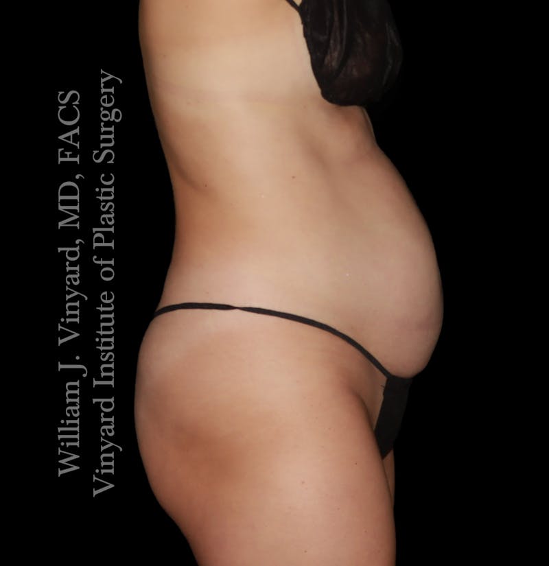 Tummy Tuck Before & After Gallery - Patient 342130 - Image 3