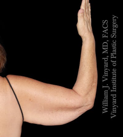 Arm Lift Before & After Gallery - Patient 366141 - Image 1