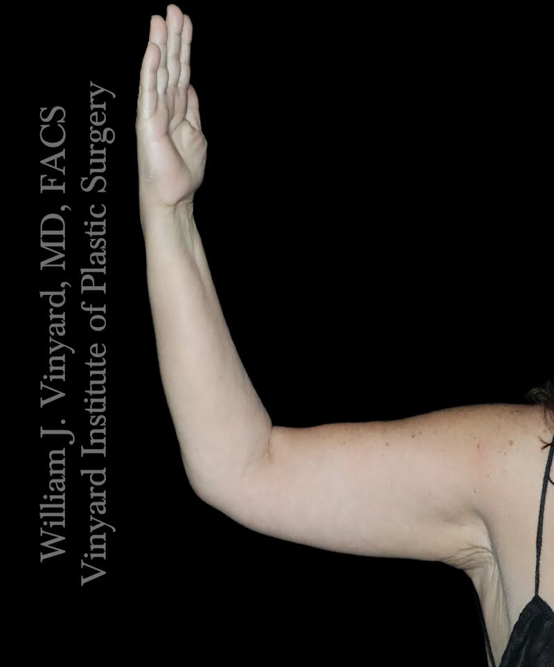 Arm Lift Before & After Gallery - Patient 366141 - Image 4