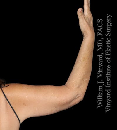 Arm Lift Before & After Gallery - Patient 366141 - Image 2