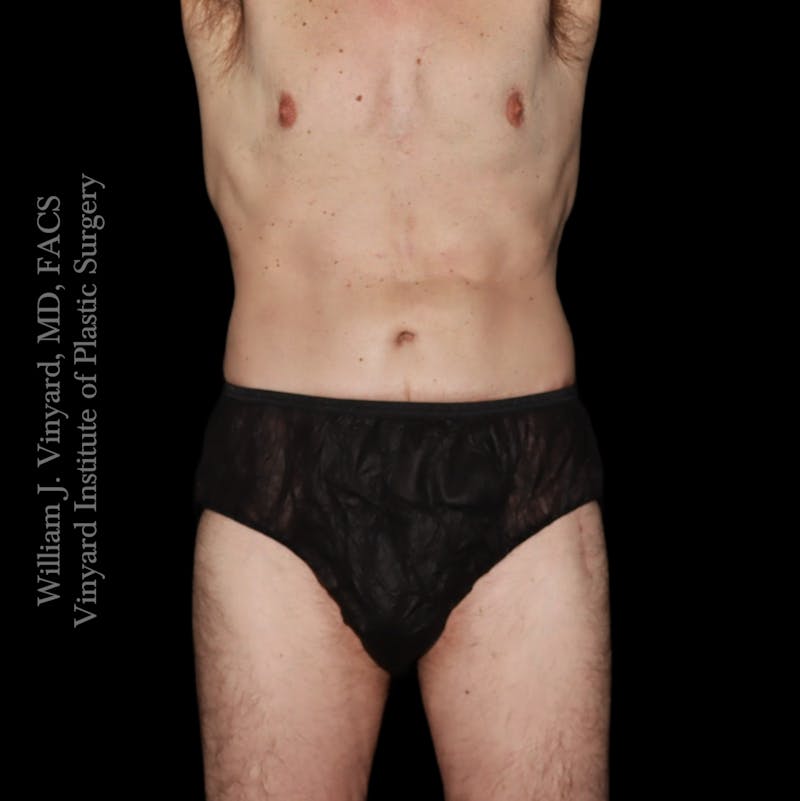 Tummy Tuck Before & After Gallery - Patient 197297 - Image 2