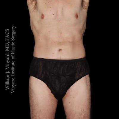 Tummy Tuck Before & After Gallery - Patient 197297 - Image 2