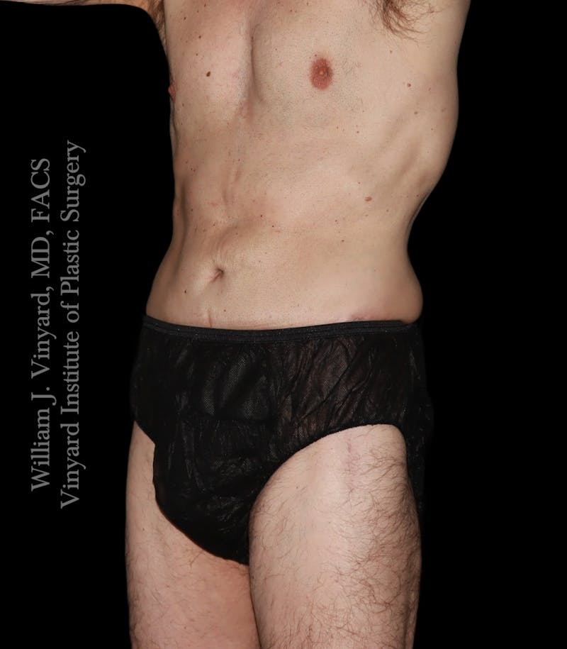 Tummy Tuck Before & After Gallery - Patient 197297 - Image 4