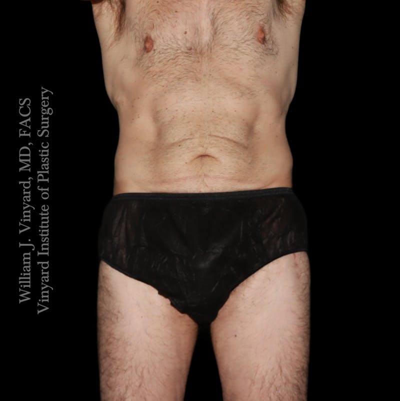 Tummy Tuck Before & After Gallery - Patient 197297 - Image 1