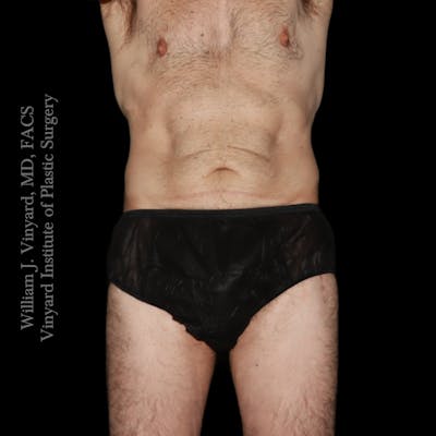 Tummy Tuck Before & After Gallery - Patient 197297 - Image 1