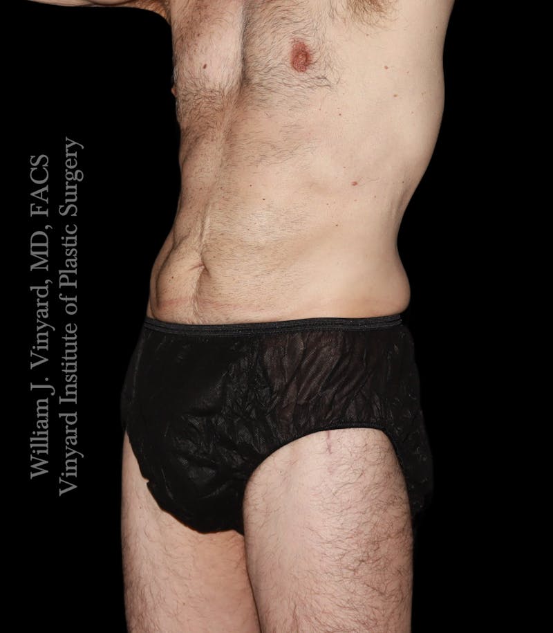 Tummy Tuck Before & After Gallery - Patient 197297 - Image 3