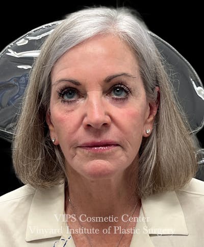Laser Skin Resurfacing Before & After Gallery - Patient 172252 - Image 2