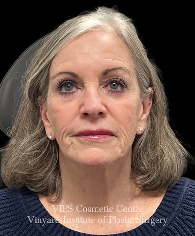 Laser Skin Resurfacing Before & After Gallery - Patient 172252 - Image 1
