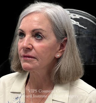 Laser Skin Resurfacing Before & After Gallery - Patient 172252 - Image 4