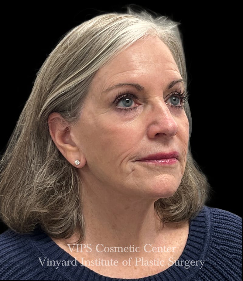 Laser Skin Resurfacing Before & After Gallery - Patient 172252 - Image 5