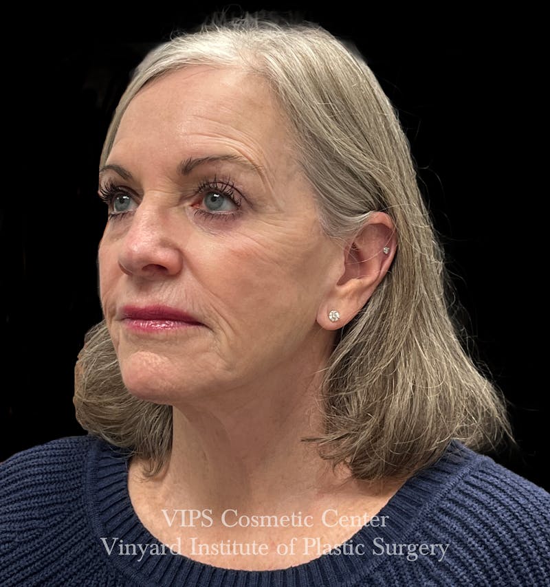 Laser Skin Resurfacing Before & After Gallery - Patient 172252 - Image 3