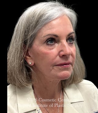 Laser Skin Resurfacing Before & After Gallery - Patient 172252 - Image 6