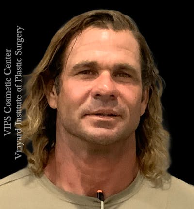 Wrinkle Fillers Before & After Gallery - Patient 400907 - Image 2