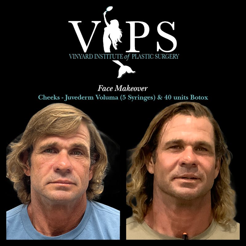 Wrinkle Fillers Before & After Gallery - Patient 400907 - Image 3