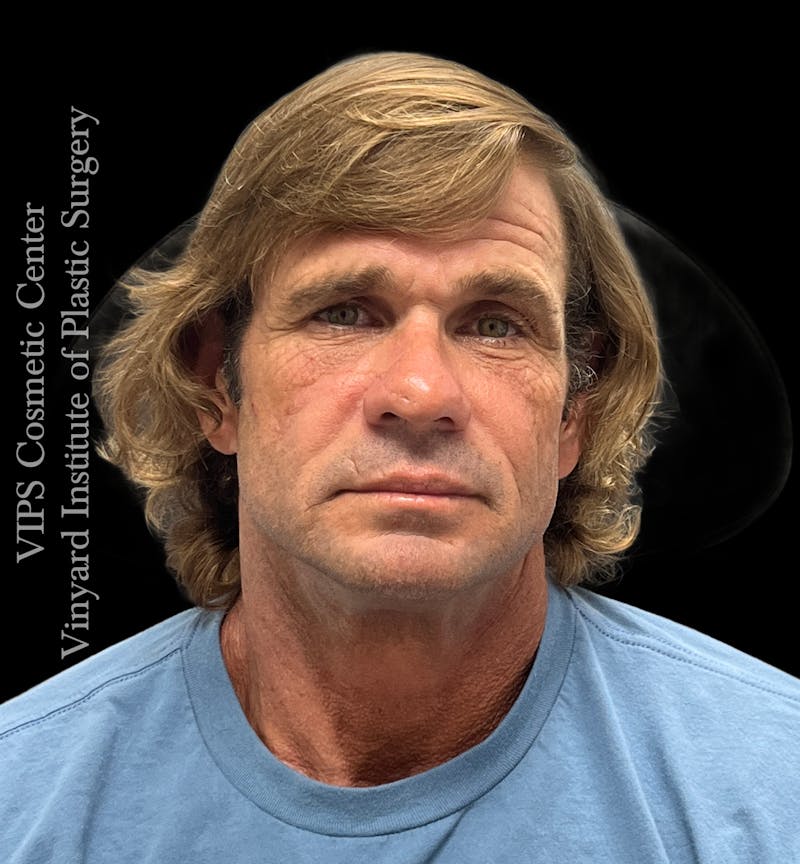 Wrinkle Fillers Before & After Gallery - Patient 400907 - Image 1