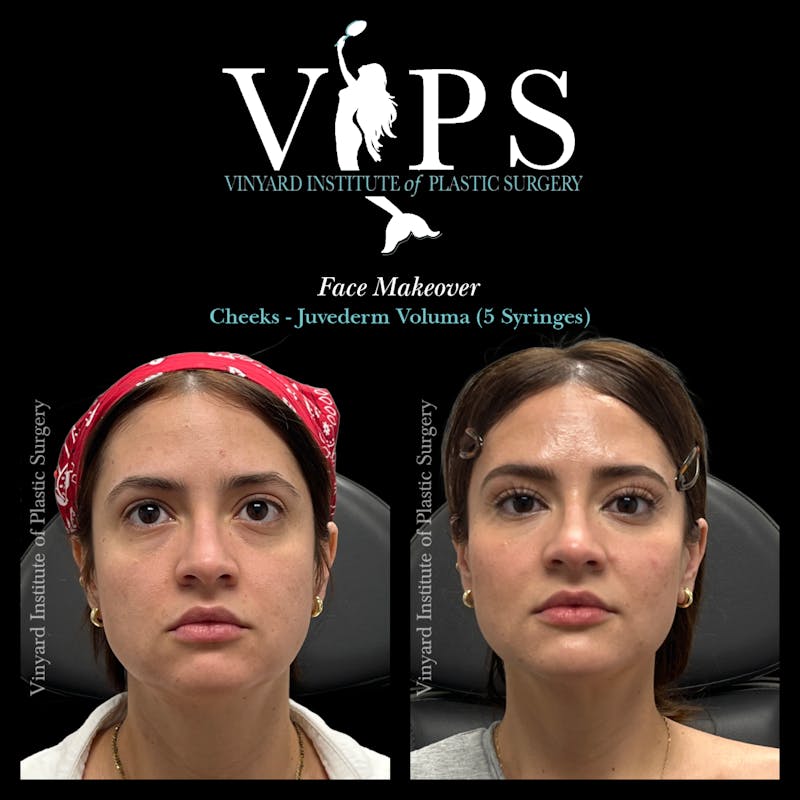 Wrinkle Fillers Before & After Gallery - Patient 134143 - Image 6