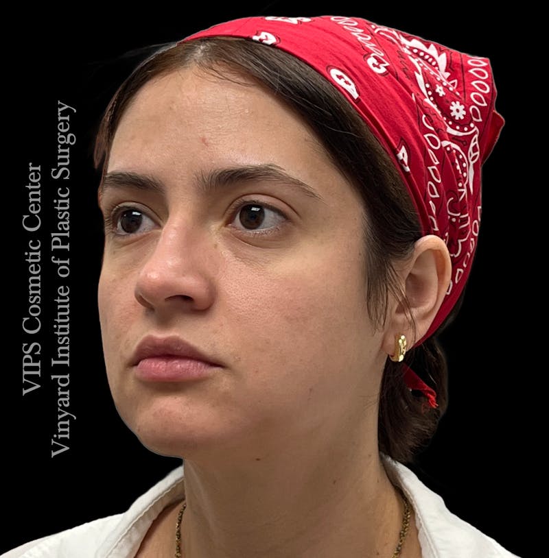 Wrinkle Fillers Before & After Gallery - Patient 134143 - Image 3