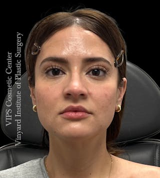 Wrinkle Fillers Before & After Gallery - Patient 134143 - Image 2