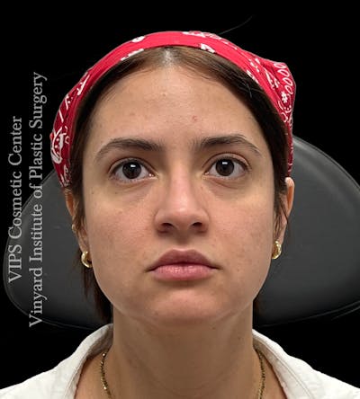Wrinkle Fillers Before & After Gallery - Patient 134143 - Image 1