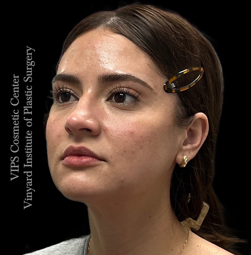 Wrinkle Fillers Before & After Gallery - Patient 134143 - Image 4