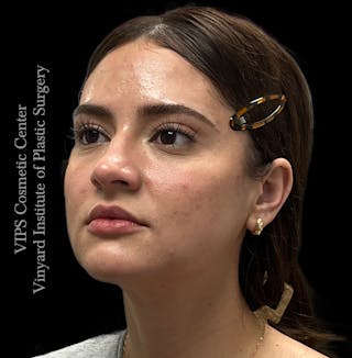 Wrinkle Fillers Before & After Gallery - Patient 134143 - Image 4