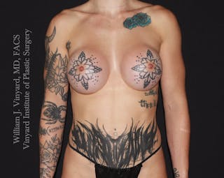 Breast Augmentation Before & After Gallery - Patient 386130 - Image 2