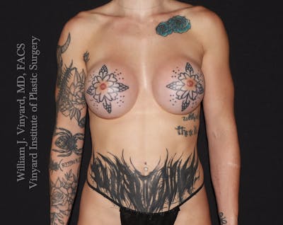 Breast Augmentation Before & After Gallery - Patient 386130 - Image 2