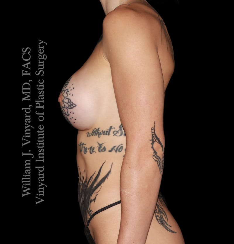 Breast Augmentation Before & After Gallery - Patient 386130 - Image 4