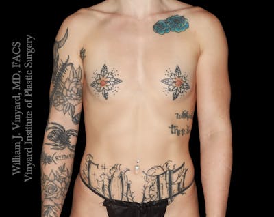 Breast Augmentation Before & After Gallery - Patient 386130 - Image 1